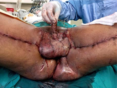 hidradenite reconstrução genital.jpg