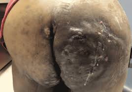 hidradenite supurativa 7.jpg