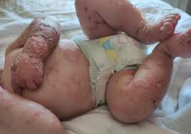 PENFIGO BOLHOSO4.jpg