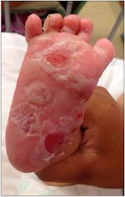 penfigo bolhoso 9.jpg