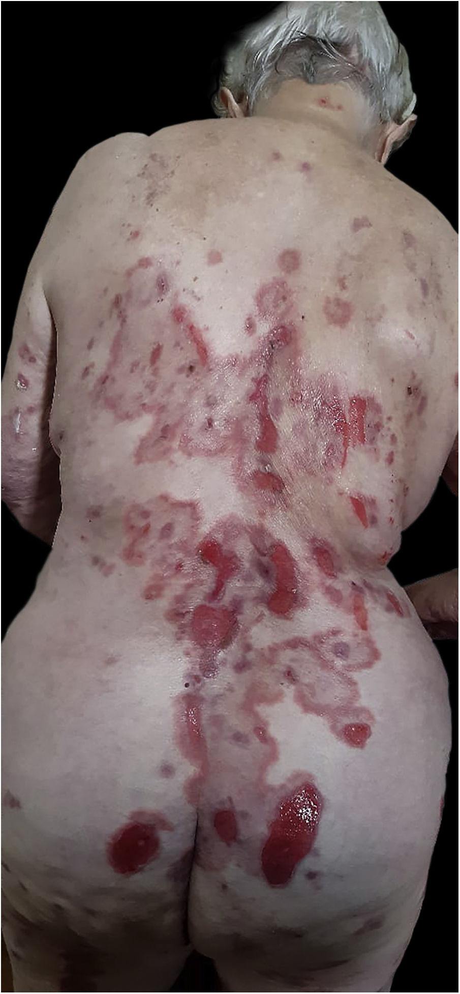 penfigo bolhoso10.jpeg