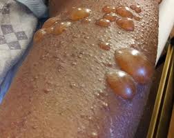 PENFIGO BOLHOSO2.jpg