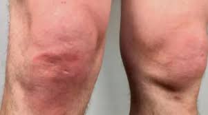 artrite psoriatica 7.jpg