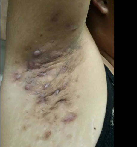 hidradenite supurativa.png