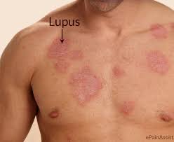 LUPUS 4.jpg