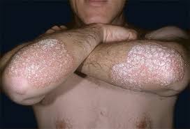 psoriase5.jpg